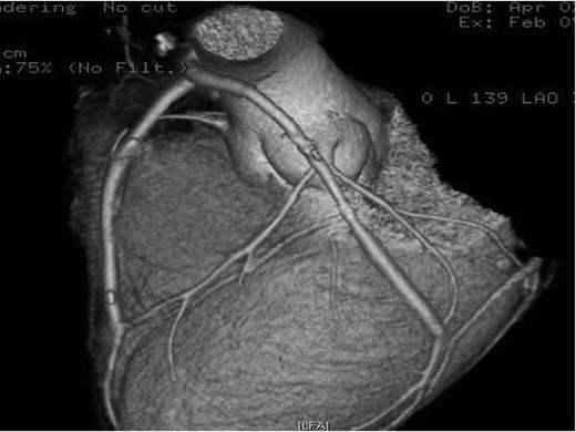 CT coronary angiography reconstruction showing patent grafts to the LAD and obtuse marginal arteries.
