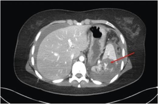 CECT demonstrating a grade 4 splenic injury with contrast extravasation suggesting active haemorrhage (arrow).