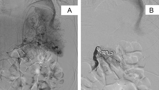 Selective digital subtraction angiography pre- and post-splenic artery embolization. (A) Pre-embolization image demonstrating multiple focal areas of haemorrhage. (B) Post-embolization image demonstrating coils within the main splenic artery with early filling of collateral vessels.