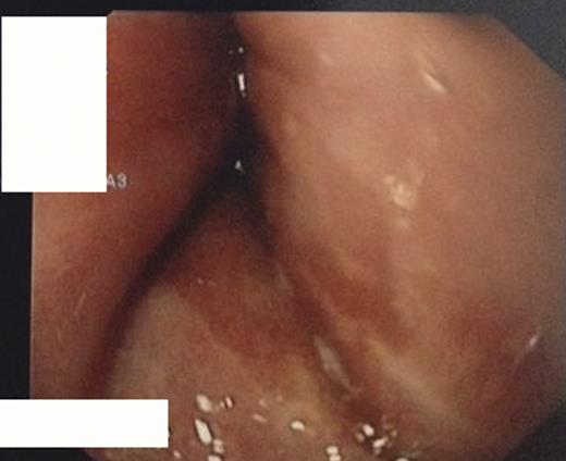 Obstructing mucosal fold at endoscopy.