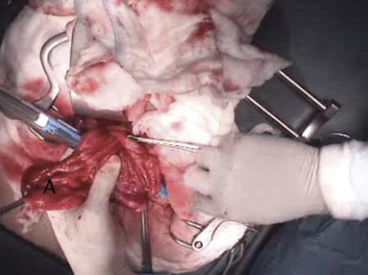 Intra-operative picture of the obstructing gastric mucosal fold (A) being prepared for transection.