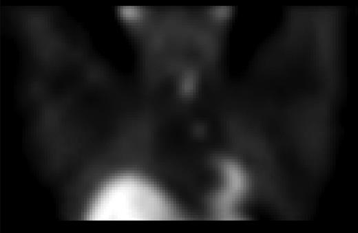 Sestamibi/SPECT imaging indicating a parathyroid adenoma in the mediastinum