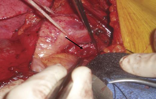 Intraoperative photograph showing the cut edge of the pericardium and the parathyroid adenoma just lateral to the aortic root (arrow)