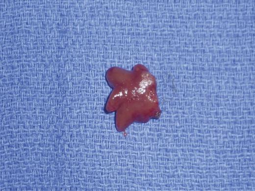 0.610 g parathyroid adenoma removed in its entirety