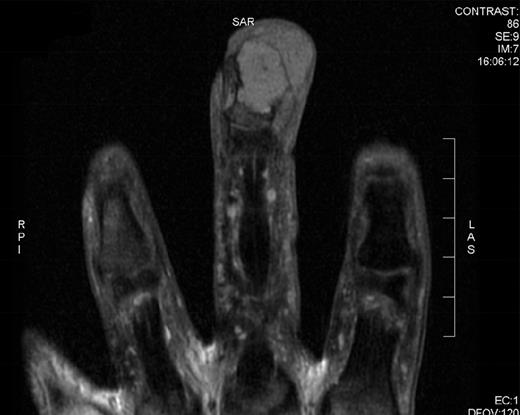 CT of the right middle finger showing a soft tissue lesion with increased vascularity, cortical irregularity of the distal phalanx and bone erosion.