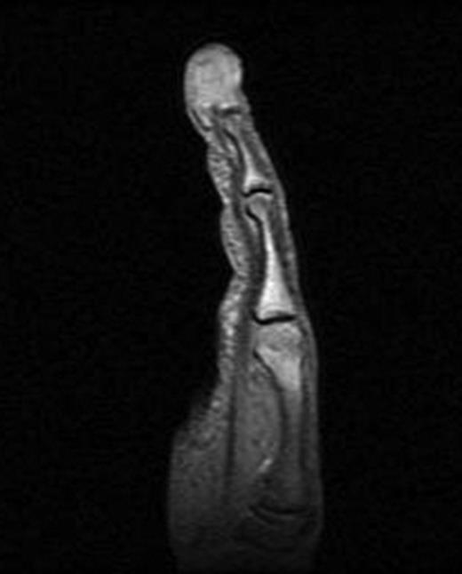 MRI of the right middle finger showing a vascularly destructive space occupying lesion 23 × 15 × 20 mm in size. The mass was multiloculated and causing severe erosion of distal interphalangeal bone. There lesion was iso-intense on T1 weighting, homogenously hypo-intense on STIR sequences and showed intense homogenous enhancement on post gadolinium fat sat T1 sequences.