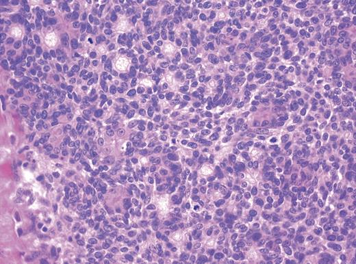 Histology of ADPA showing a high mitotic grade lesion with a small focus of lymphovascular invasion.