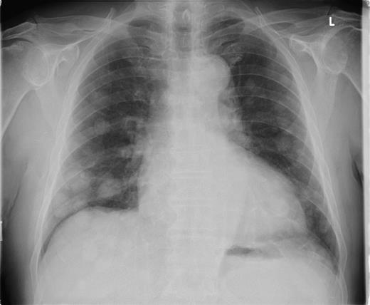 Plain chest radiograph taken 17 months after excision of the primary lesion showing multiple pulmonary metastasis.