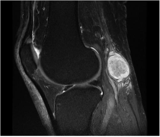 Preoperative MRI image.