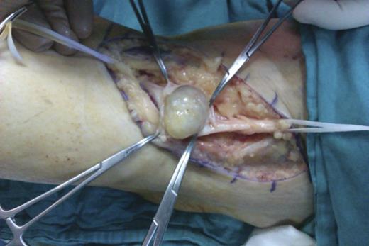 Intraoperative image.