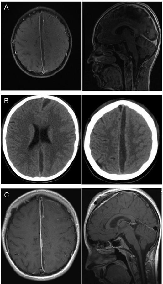 Twelve-year-old boy with parafalcine subdural empyema. (A) Axial and saggital MRI section with administration of gadolinium. A parafalcine subdural empyema frontoparietal with left-side compression of the brain. It is seen a diffuse edema of the left hemisphere. (B) Axial native CT section. An enlargement of the empyema is visible 4days after first surgery with a diffuse edema of the left hemisphere without a significant midline shift. (C) Axial and sagittal MRI section with administration of gadolinium. Regression of the empyema is visible after the second surgery. A regressive edema of the left hemisphere is visible, especially the frontal abscess conglomerate is reduced.