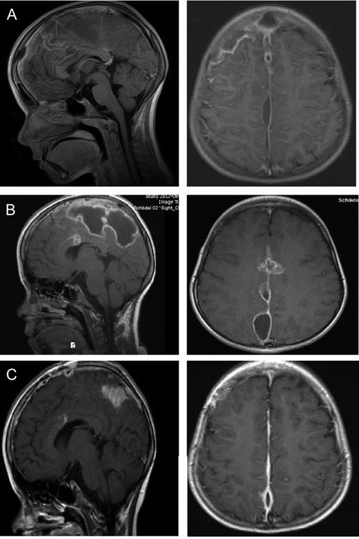 Eight-year-old girl with parafalcine subdural empyema. (A) Axial and sagittal MRI section with administration of gadolinium. Space occupying empyema with the largest expansion right frontal and contact to the falx. Perifocal edema without a significant midline shift is seen. (B) Axial and sagittal MRI section with administration of gadolinium. An enlargement of the empyema is visible after first surgery. The empyema is localized in central parasagittal region with a significant space-occupying component with a compression of the right central region. (C) Axial and sagittal MRI section with administration of gadolinium. A regression is visible after second surgery. In comparison to preoperative MRI, a notable decrease in the space-occupying part of the empyema is seen.