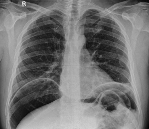 Pneumoperitoneum visible under both hemi-diaphragms.