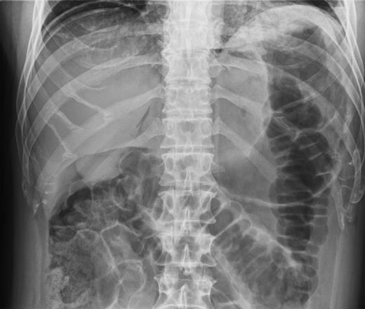 Abdominal X-ray demonstrating Rigler's sign.
