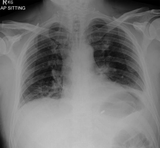 Post laparotomy, nasogastric tube in situ.
