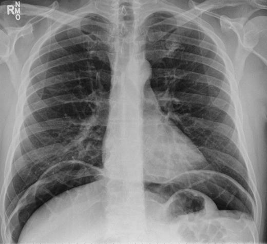 Recurrence of pneumoperitoneum.