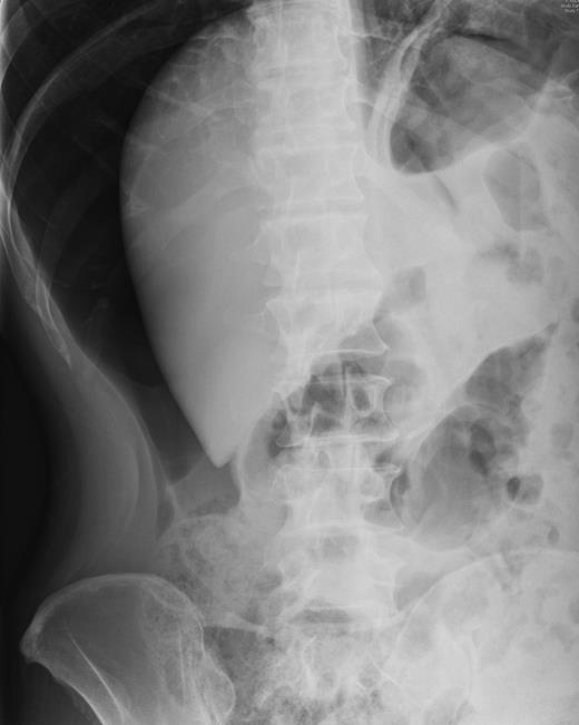 Horizontal view–air around liver.