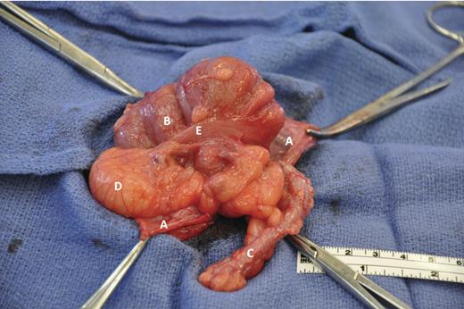 Hernia sac (A) opened containing cecum (B) and vermiform appendix (C); epiploic appendage (D), tenia coli (E).