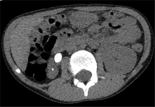 Non-contrast CT demonstrating the large right ureteric calculus.
