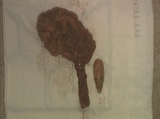 Right kidney and ureter with calculus.