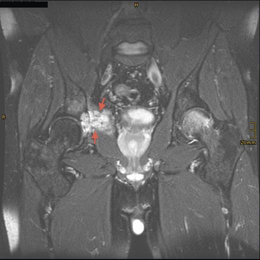Sagittal T2-weighted, fat-suppressed contrast-enhanced MRI demonstrating the tumor lesion (5 cm in diameter) in the right acetabulum (arrows) 8 years prior to presentation.