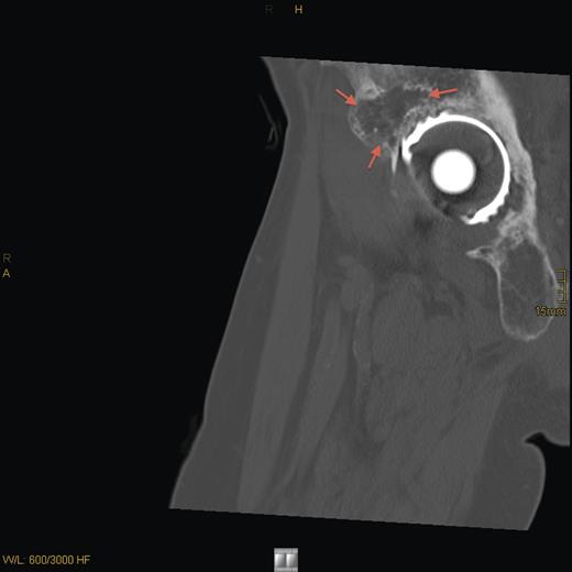 CT sagittal scan showing a suspected osteolytic lesion (arrows) in the right os ilium (8 years after primary resection).