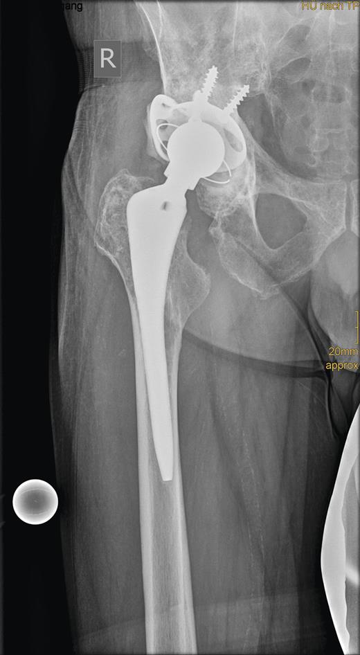 Radiograph showing the roof reinforcement ring with the cemented low profile cup after revision surgery.