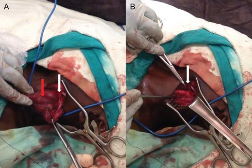 Intraoperative images of left neck (cranial to caudal from right to left). (A) The branchial cleft cyst in situ (red arrow), with the hypoglossal nerve indicated by the white arrow. (B) The left neck after removal of the cyst, with the intact nerve visible at the tip of the hemostat (white arrow).