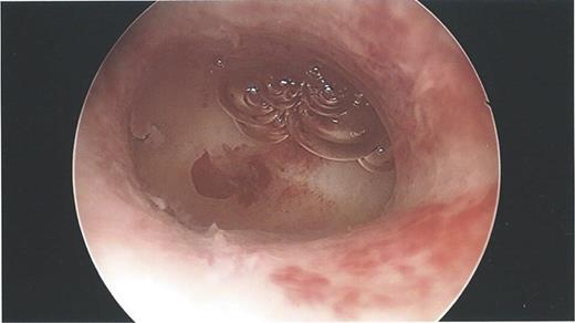 Hysteroscopy showing a normal endometrial cavity, no evidence of IUCD or site of perforation.