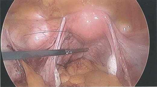 Laparoscopy showing normal IUCD threads deep inside the Pouch of Douglas inside the sigmoid colon.