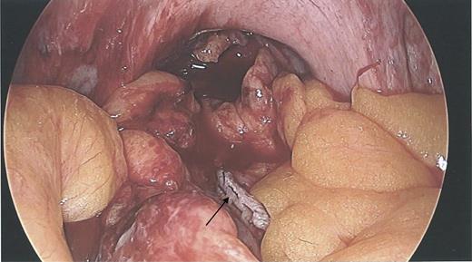 Laparoscopy showing a sigmoid colon post-repair after removal of coil.