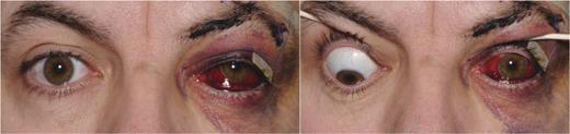 Preoperative clinical presentation in straight (left) and down gaze (right) view shows hyperopia and a restriction of infra-duction.