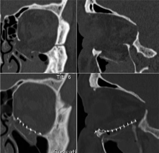 The preoperative (a) and postoperative (b) CT of the left orbital floor fracture showing a satisfactory reposition of periorbital tissue and reconstruction of the orbital floor with a titanium-mesh.