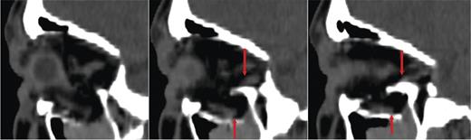 The preoperative 0.5 mm sliced CT of the orbit presents the tear of the IR muscle in his middle part.