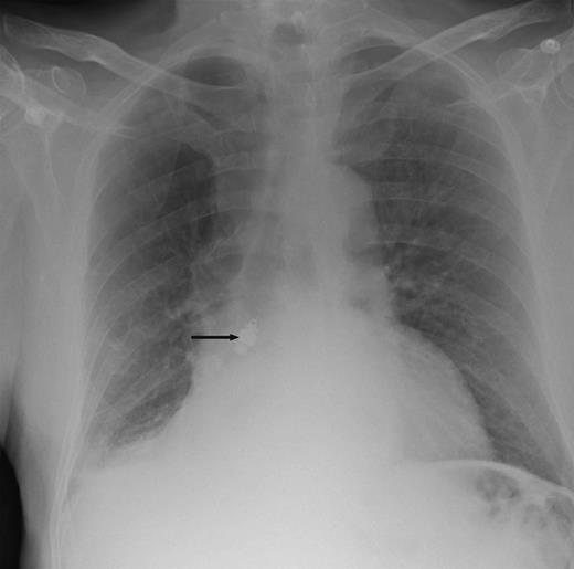 Chest X-ray showing a metallic foreign body impacted in the right bronchus with collapse of the middle and lower lobes on the right side.