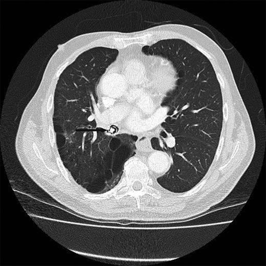 CT scan showing the metallic object in and completely obstructing the bronchus intermedius.