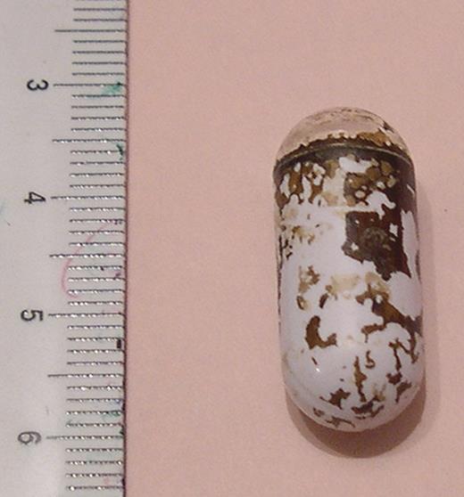 Capsule endoscope retrieved by bronchoscopy.