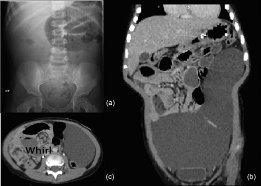 (a) Abdominal X-ray revealing small bowel obstruction in the left upper quadrant. (b) Abdominal-pelvic CT coronal image revealing 13 × 21 × 9 cm intraperitoneal cystic lesion. (c) Abdominal-pelvic CT axial image shows the classic whirl of mesenteric volvulus.