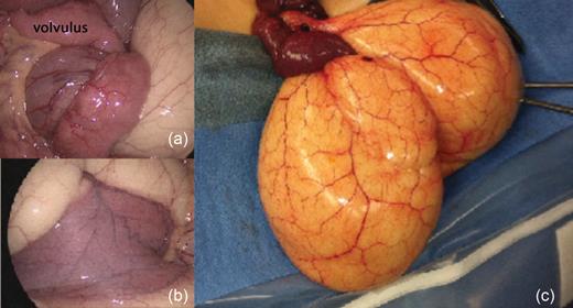 (a) Laparoscopic image of small bowel volvulus at base of lymphatic malformation. (b) Segment of small intestine with lymphatic malformation arising from its mesentery. (c) Intraoperative image of lymphatic malformation after partial aspiration of chylous fluid to allow delivery through the incision.