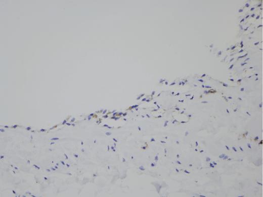 Histologic cross-section of the surgical specimen after staining for D2–40 expression confirming the lymphatic origin of the cystic lesion.