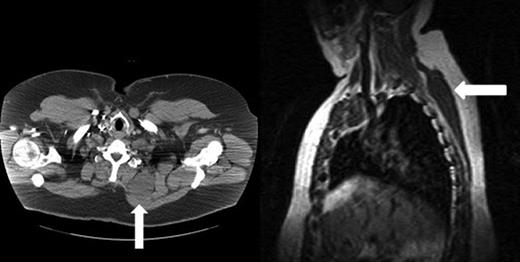 (Left) Chest CT scan shows the large cystic mass (arrow) between the left posterior ribs and muscles of the left back and scapula. No solid or enhancing components are identified. (Right) Chest MRI shows the large cystic mass extending from the level of the lower neck to just above the level of the diaphragm.
