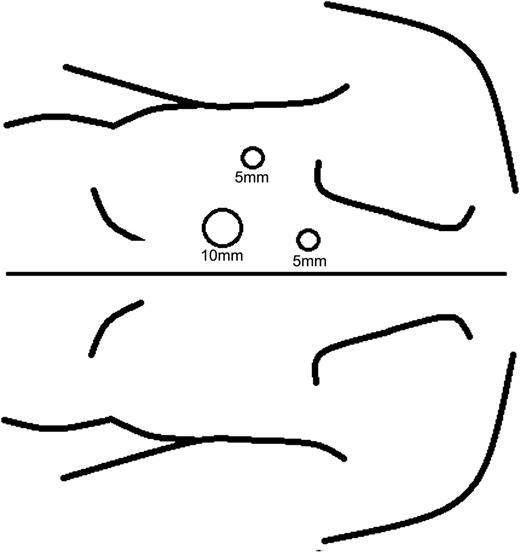 Location and size of trocars.