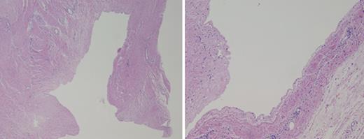 Histology of the cyst shows the lack of a true epithelial lining. No malignant features are visualized.