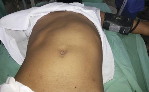 Lump in abdomen over left hypochondrium.