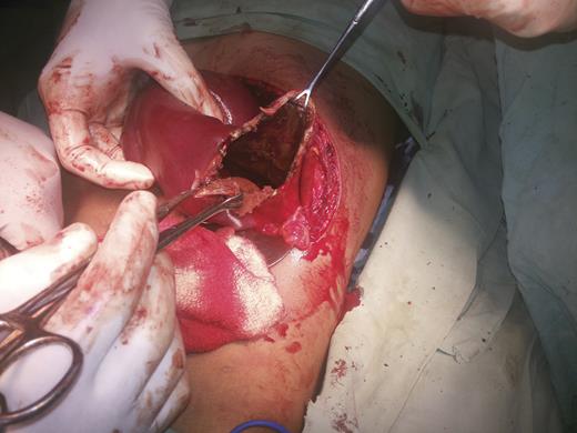 Intraoperative picture of the first patient.