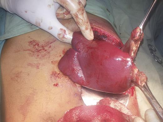 Intraoperative picture of the first patient.