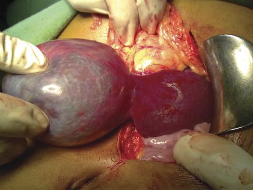 Intraoperative picture of the second patient.