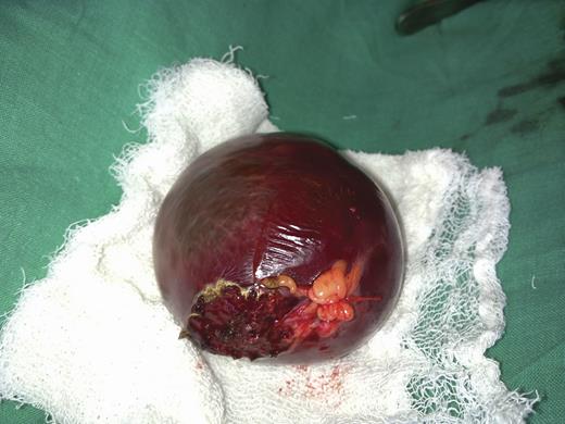 Specimen of the cyst removed from the second patient.