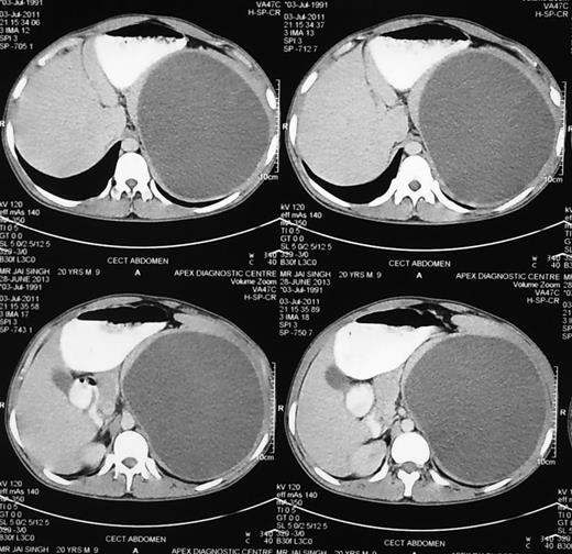 CECT abdomen showing a huge splenic mass.