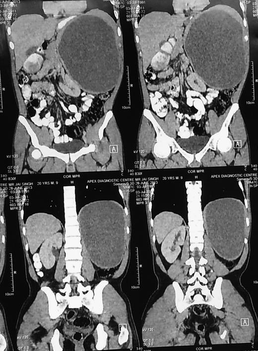 CECT abdomen showing huge splenic mass compressing surrounding structures.
